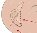 耳前、耳后的小拉皮手术切口图