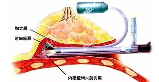 <!--<i data=20240705-sp></i>-->陈成假体隆胸辅助内窥镜设备损伤小