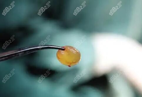 用内窥镜技术取出的整个奥美定
