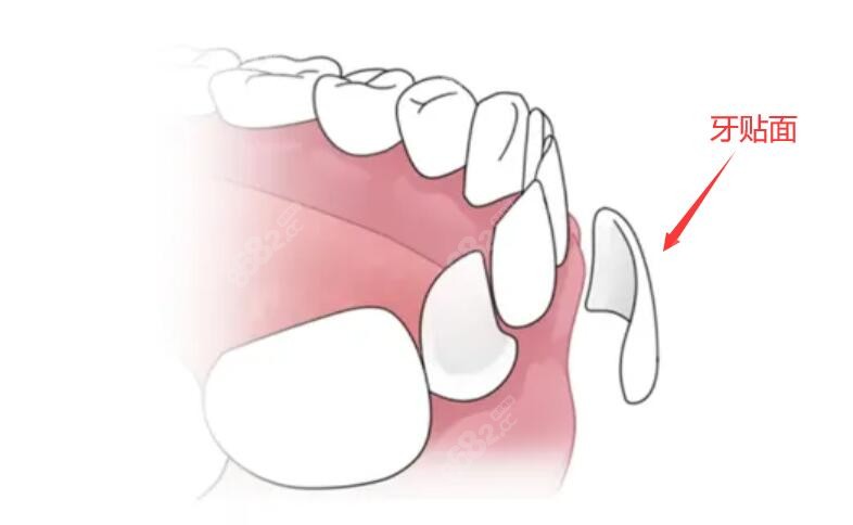 单颗牙齿瓷贴面图片