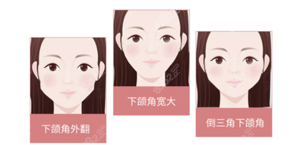 宁波下颌角截骨手术价格