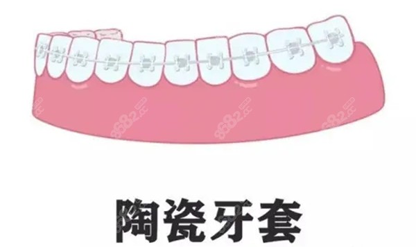 4bc2866024374176a16697f85820bb78.jpg 医生为什么不推荐陶瓷牙套呢