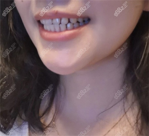 牙缝大适合隐适美牙套吗？