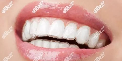 全隐形牙齿矫正的优缺点