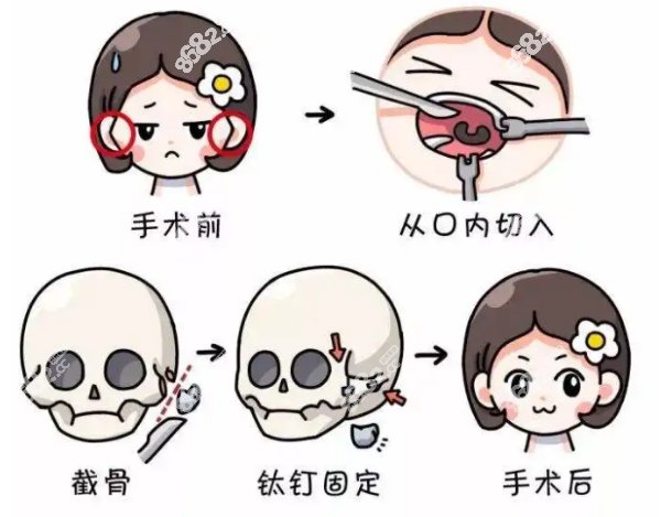 宁波做颧骨磨骨整形手术多少钱