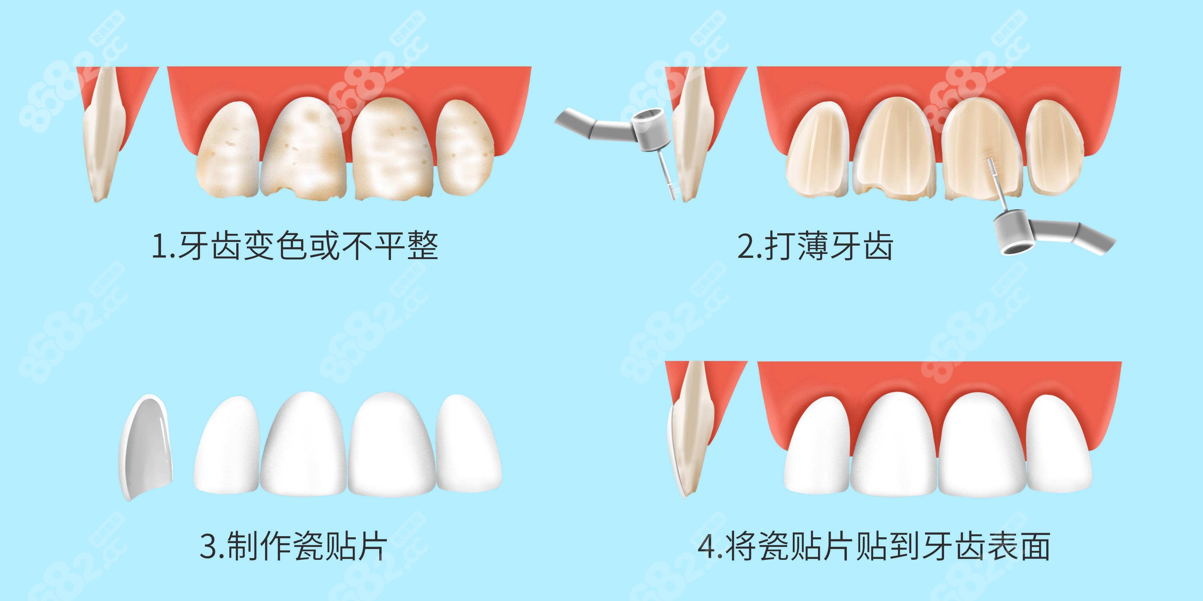 X-CERA Multilayer SHT 氧化锆瓷块 - 义齿氧化锆瓷块 - 深圳翔通医疗科技有限公司