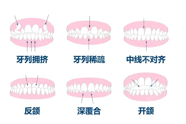 小孩矫正为什么要分两期进行