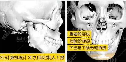 peek修复下颌角方案设计
