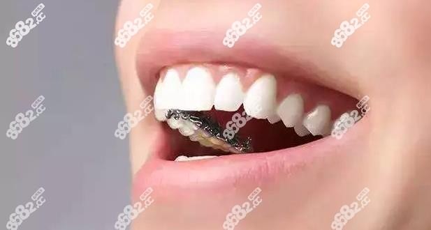 舌侧隐形牙齿矫正的优缺点