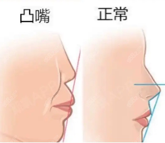 骨性凸嘴必须做正颌手术吗