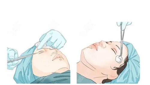 孝感双眼皮修复多少钱？
