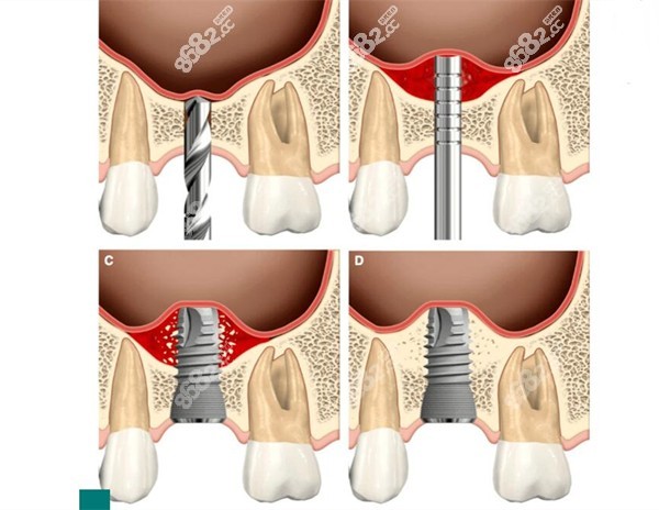 為什麼做種植牙還要做上頜竇提升手術