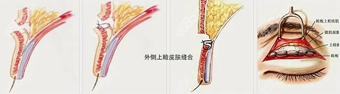 双眼皮修复
