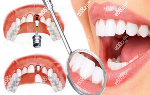 种植牙过程图示