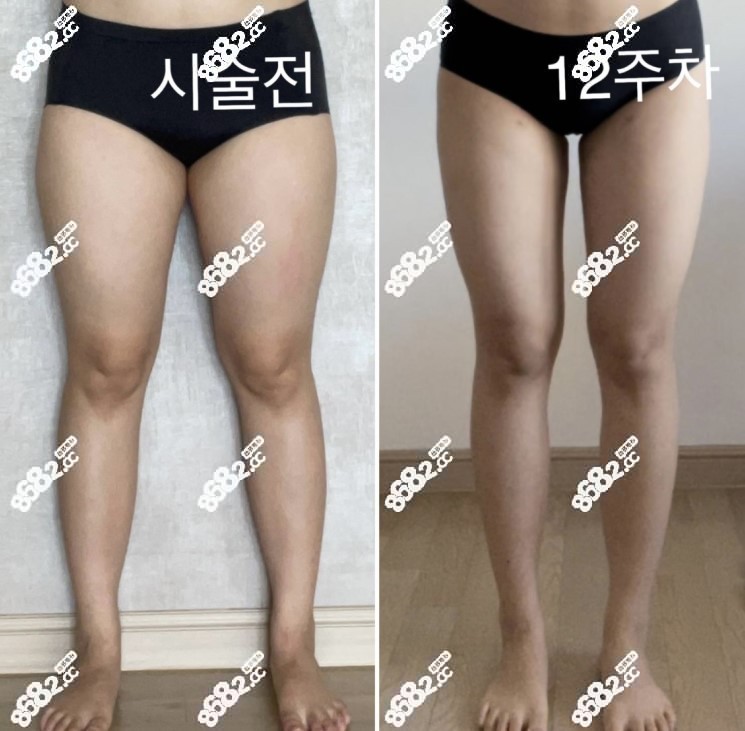 大腿无限兰斯的第12周前后对比图