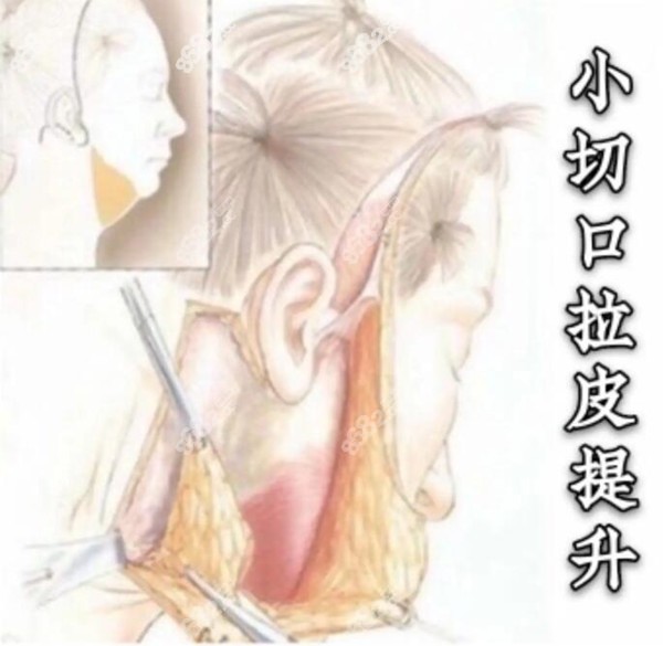 库尔勒天姿整形面部拉皮手术