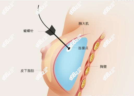 韩国乳房重建手术费用