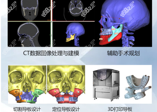 广州美恩整形美容医院做正颌手术的优势技术