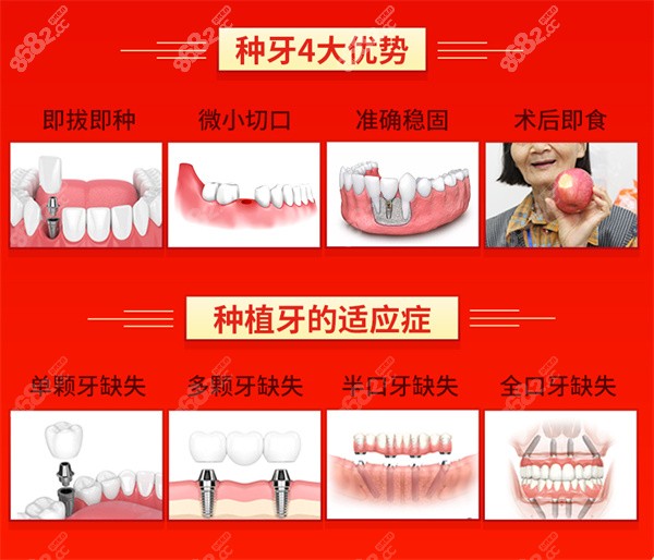 种植牙的优势图