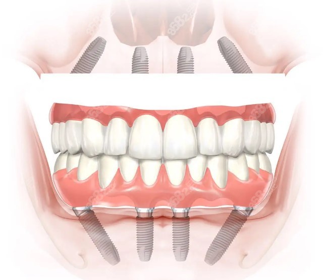 温州全口种植牙多少钱