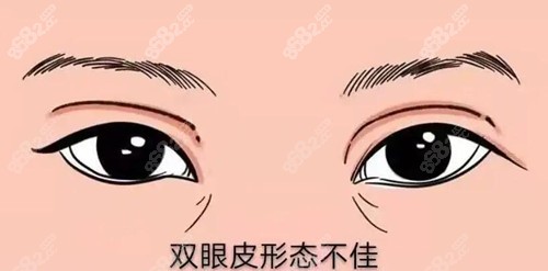 孝感双眼皮疤痕修复医院