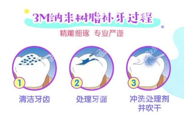 美国3M纳米树脂补牙过程图