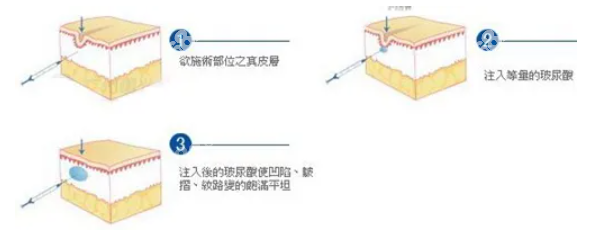 30支/60支/100支玻尿酸隆胸费用