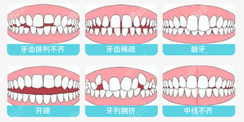 桂林柏乐口腔做牙齿矫正的类型图