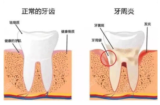 牙周炎导致的牙齿松动