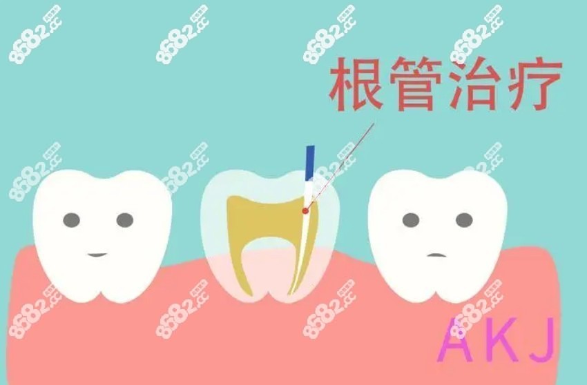 南京根管治疗加牙冠多少钱一颗