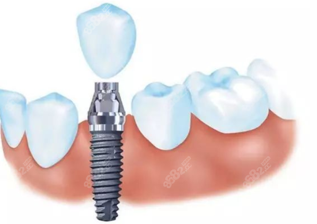 种植牙目前比较常用