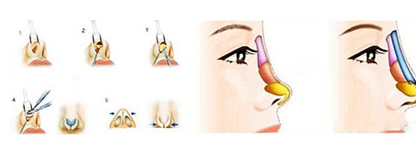 做膨体隆鼻修复手术原理图