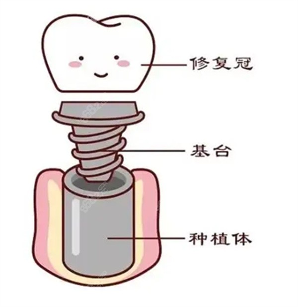种植牙的修复冠基台和种植体