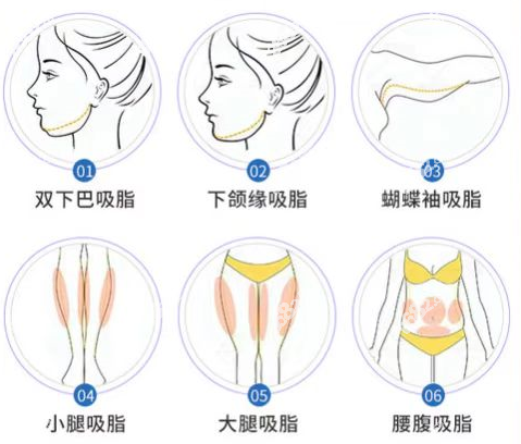 桂林吸脂减肥好的医院收费贵吗