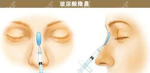 玻尿酸隆鼻