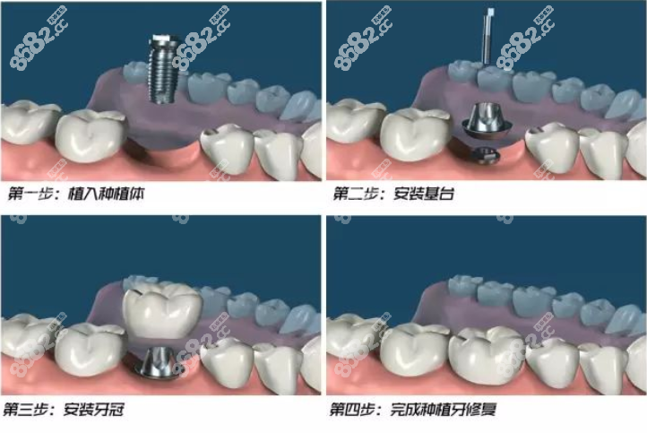 种植牙的全过程