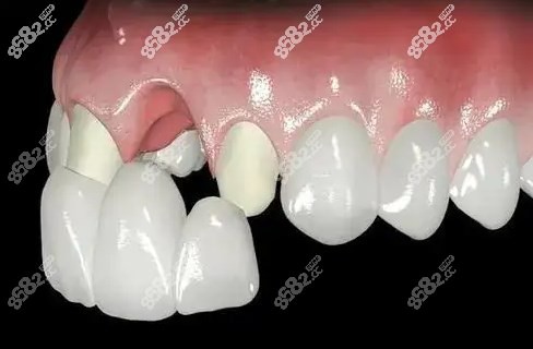 良心牙医都不建议做全瓷牙的原因