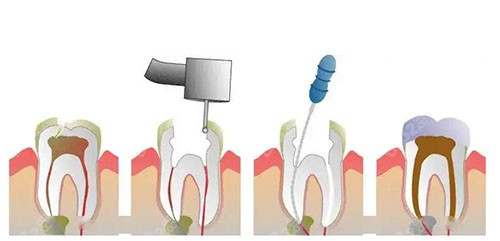 根管治疗