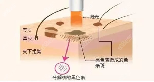 郑州激光祛斑价格多少