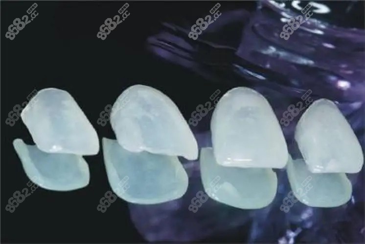 牙齿贴面有哪些材料可以选择的?说下牙齿贴面材料的5种类型