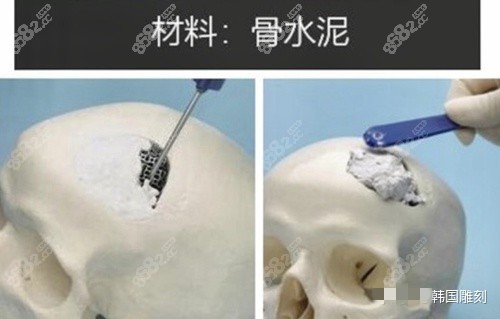 頭頂填充整形使用的材料靠譜嗎？