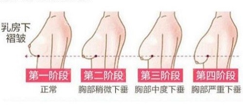 乳房下垂