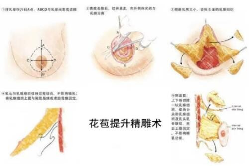 花苞提升術(shù)手術(shù)方式
