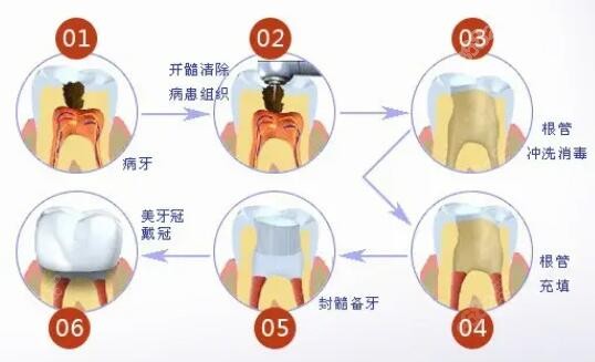 根管治疗步骤图片