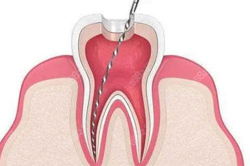 根管治疗