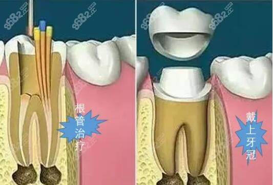 根管治疗后必须做牙套吗？