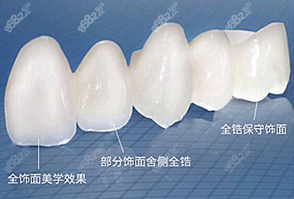 全瓷牙特点