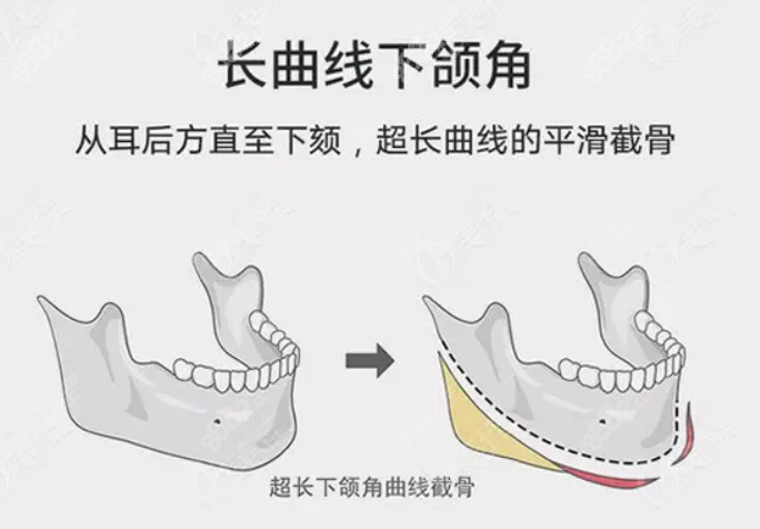 北京圣嘉新长曲线下颌角手术图示