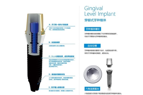 JTK种植体系统—穿龈式