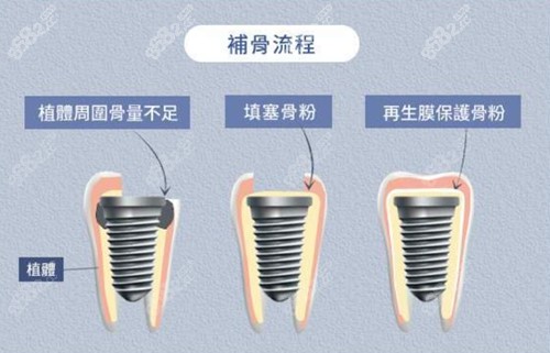 种植牙骨粉收费价格表